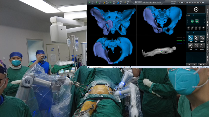 罗森博特| 智能化手术机器人成功治疗92岁高龄骨盆骨折患者